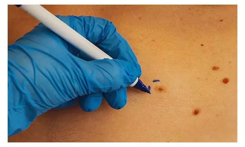 SPMC Dermatology Warns vs Self-Treating Skin Problems