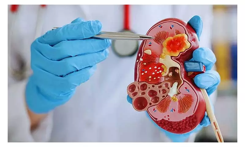 SPMC Launches Kidney & Transplant Institute in Davao on Nov 28