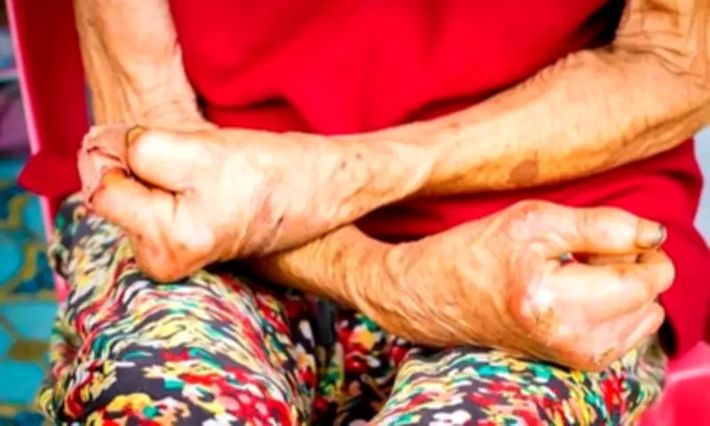 Davao City Health Office Reaffirms Free Leprosy Services for Early Detection