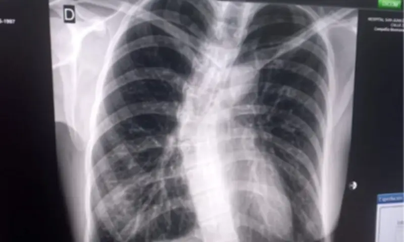 Davao Councilor Urges Early Scoliosis Care During Awareness Month