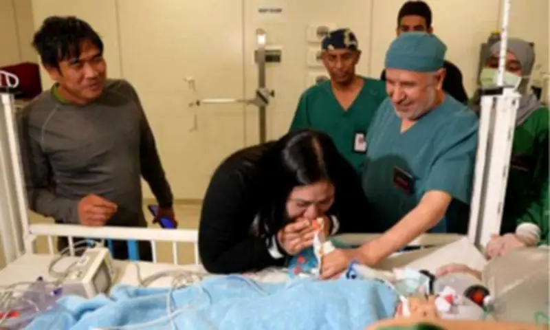 Filipino conjoined twins Olivia and Gianna successfully separated in Saudi Arabia