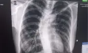 Davao Councilor Urges Early Scoliosis Care During Awareness Month