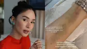 Heart Evangelista discharged from hospital, warns against overfatigue